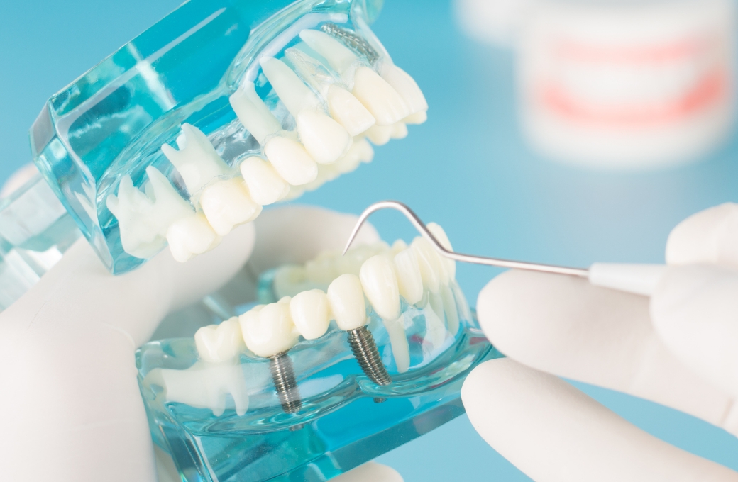 インプラント治療